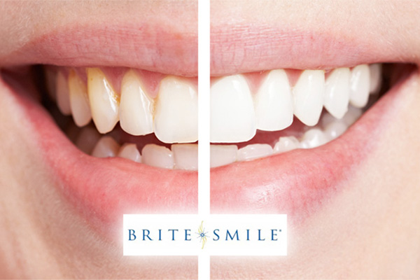 Hệ thống tẩy trắng răng chuyên nghiệp Brite Smile