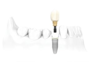Phẫu thuật cấy ghép răng Implant